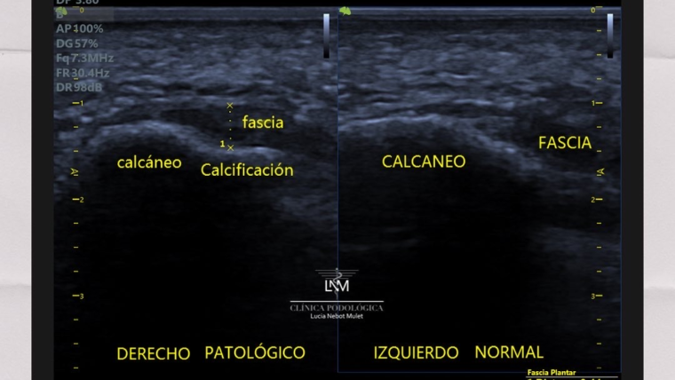 ¿Padece espolón calcáneo ? Tenemos la última tecnología para diagnosticarlo y para tratarlo!